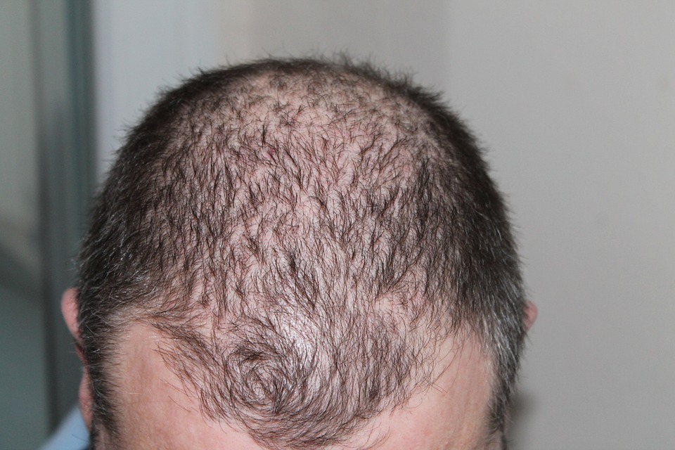 Problem of hair loss